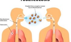 Tuberkulosis
